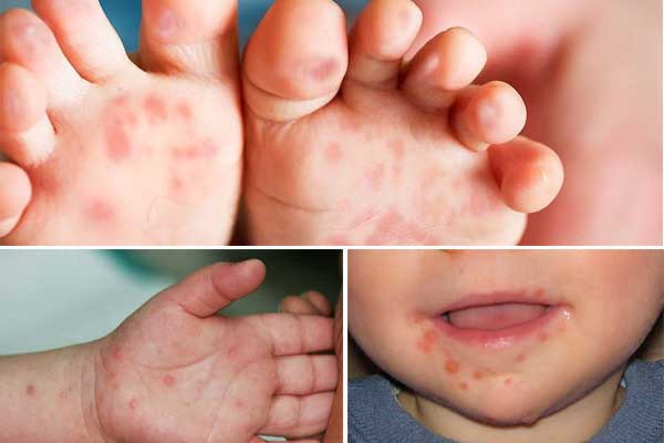 Có nhiều nguyên nhân bệnh tay chân miệng ở trẻ em