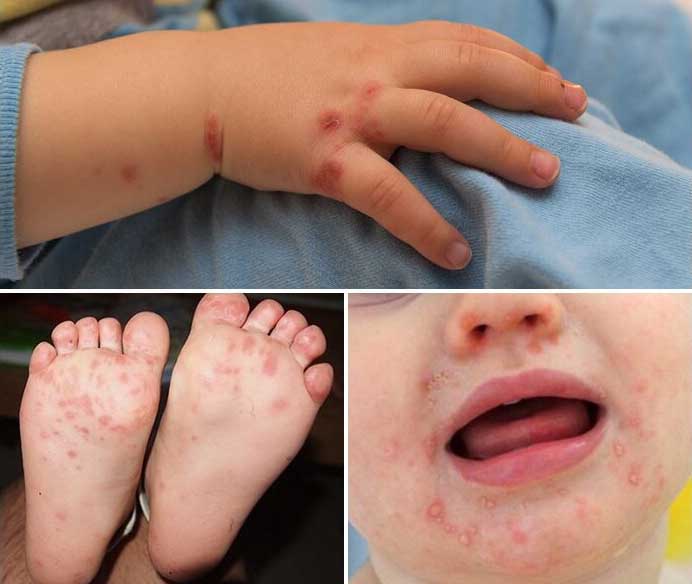Bệnh tay chân miệng ở trẻ sơ sinh có nguy hiểm không?
