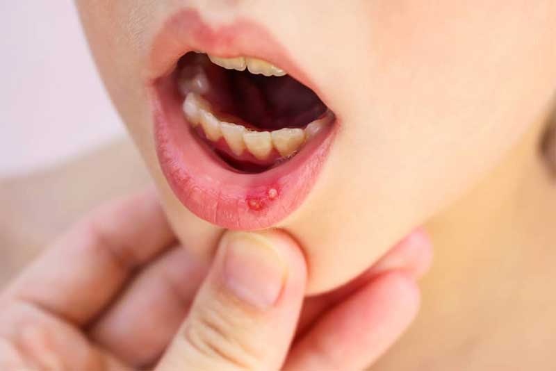 Có rất nhiều nguyên nhân khiến trẻ em bị lở miệng